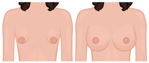Тубулярная форма груди Нормальная форма груди 