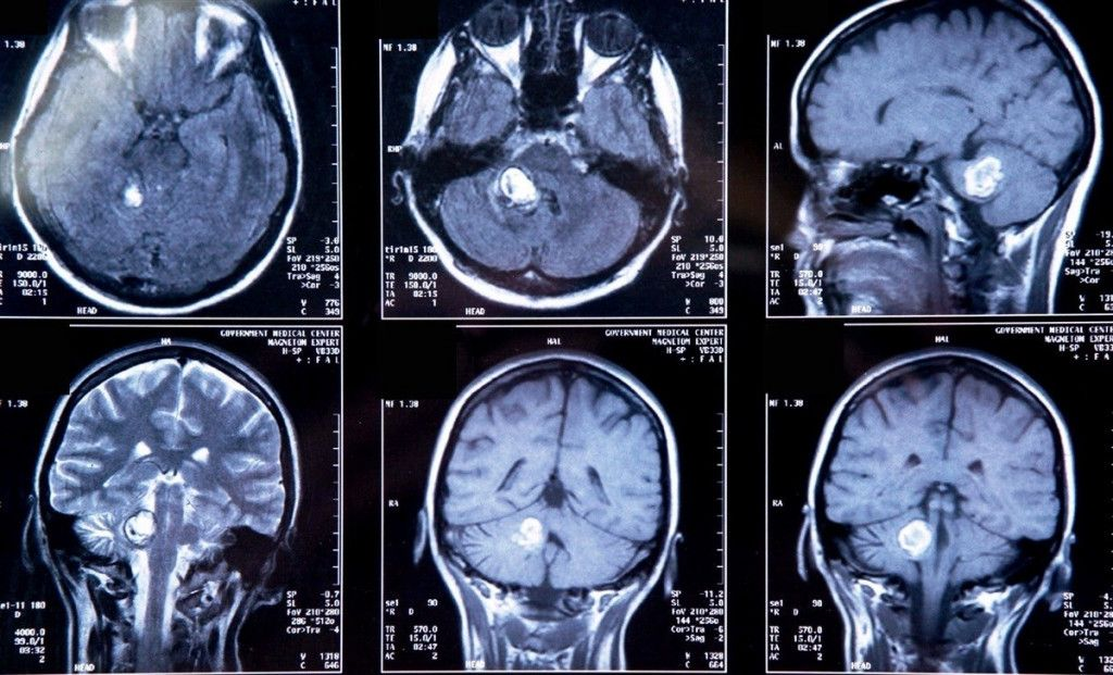 Опухоль головного мозга первый симптом. Доброкачественная опухоль головного мозга мрт. Доброкачественные опухоли головного мозга кт. Глиома головного мозга кт. Диагноз кт с опухолью головного мозга.