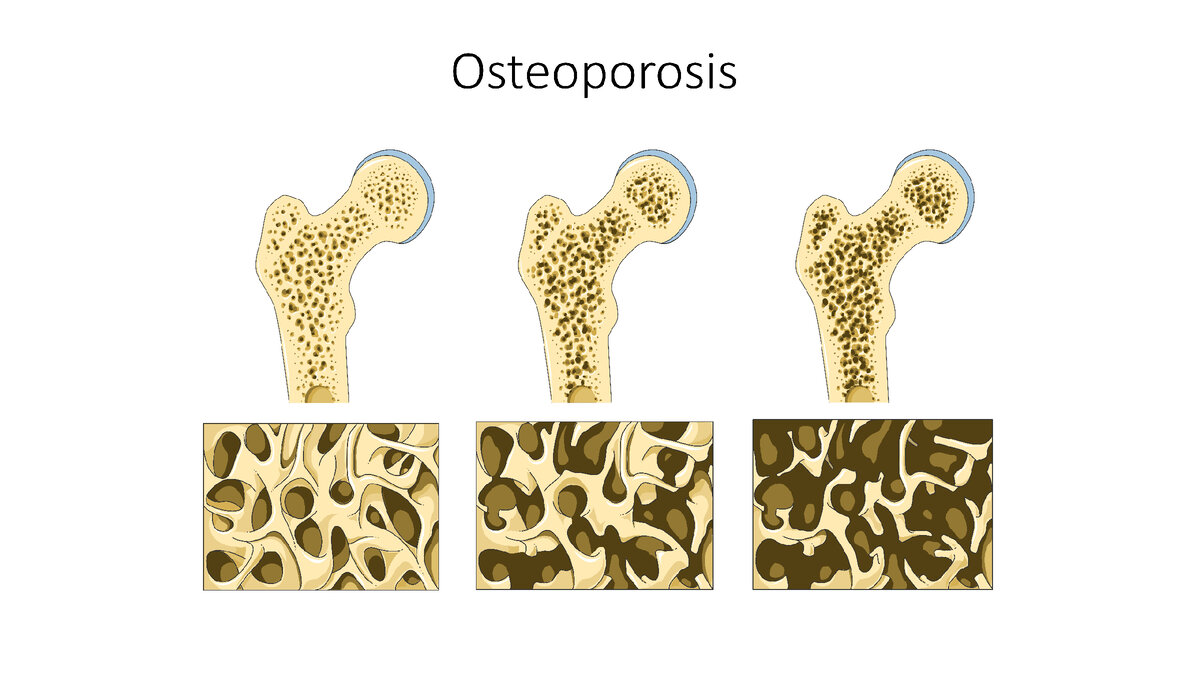 Рисунок из открытых источников - https://commons.wikimedia.org/wiki/File:Osteoporosis_--_Smart-Servier.jpg