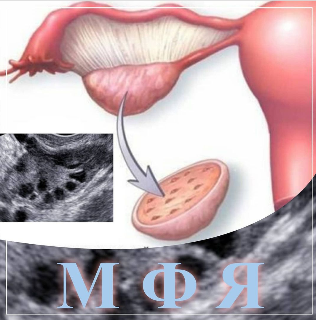 МУЛЬТИФОЛЛИКУЛЯРНЫЕ ЯИЧНИКИ НЕ ДИАГНОЗ! ⠀                                                 🔻Причины возникновения МФЯ:⠀ ➖наследственность;                                  ➖резкие изменения в массе тела;        ➖период лактации;⠀                       ➖воздействие сильного стресса;⠀  ➖длительный прием гормональных контрацептивов;⠀                                           ➖также такое явление может быть у молодых девушек в период полового созревания.⠀ ⚡Для некоторых пациенток МФЯ (мультифолликулярные яичники) — синоним СПКЯ (синдром поликистозных яичников).МФЯ – это не СПКЯ!⠀                                                 ⚡МФЯ являются просто описанием ультразвуковой картины, которая отражает наличие большого числа фолликулов в яичниках.⠀                                                      ⚡Размер и объем яичников в пределах нормы или чуть больше. Расположение фолликулов чаще беспорядочное.⠀                                  ⚡Чаще всего мультифолликулярные яичники не требуют лечения, они сопровождаются нормальной овуляцией и не препятствуют беременности.⠀                                           ⚡Лечение необходимо только, если МФЯ (с увеличением объема яичников по данным ультразвукового исследования!) сопровождаются ановуляторными циклами        (нарушением менстуального цикла) или гиперандрогенией, но тогда речь идет о СПКЯ.                              ⠀Теме СПКЯ будет посвящена отдельная статья!