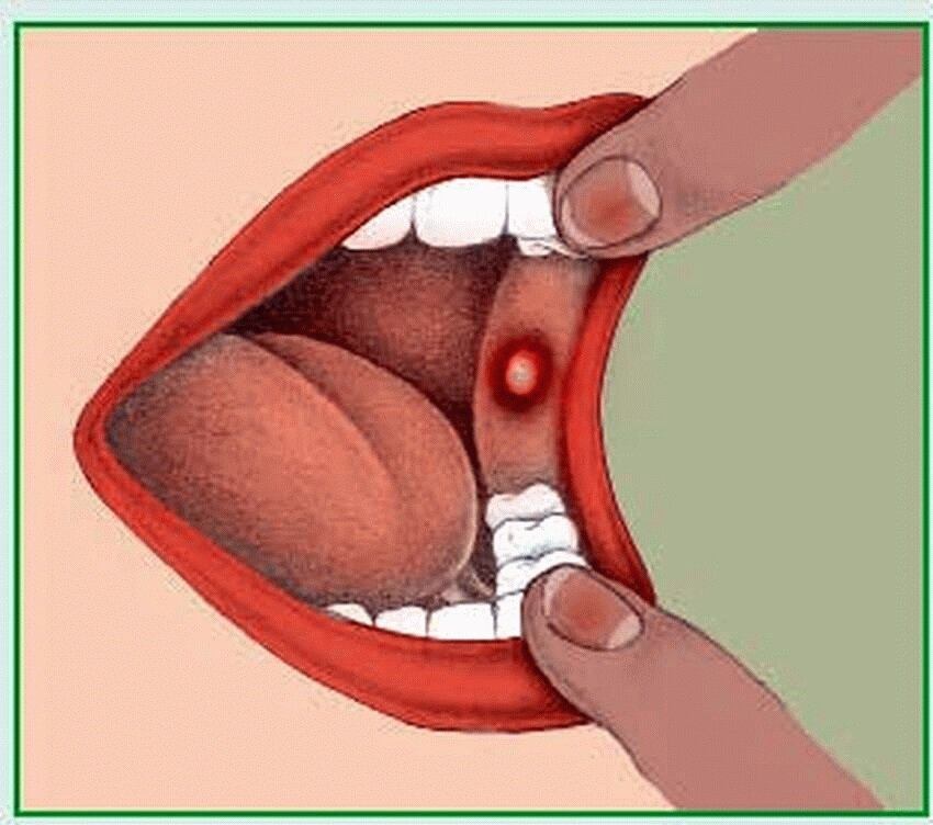Пятна Филатова - Коплика при кори.