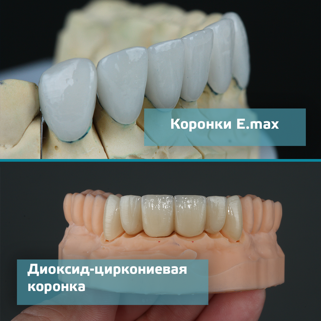 Какие бывают коронки. Виды коронок. Коронки для зубов. Виды коронок на зубы и какие лучше