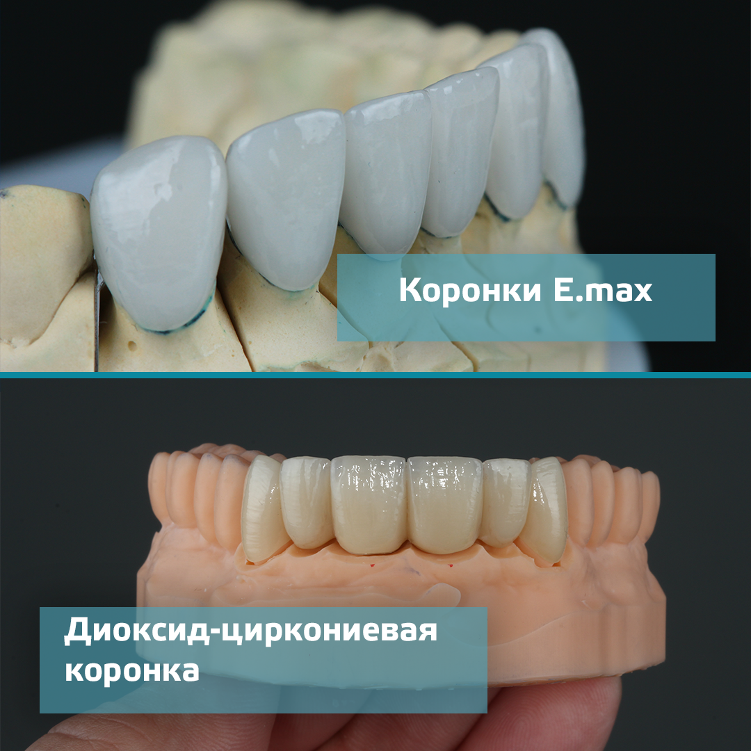 Виды коронок на зубы и какие лучше. Виды коронок. Коронки для зубов.