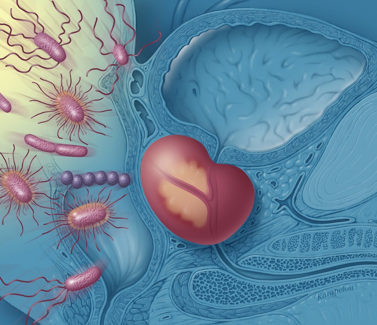 Все о ПРОСТАТИТЕ у мужчин - суть проблемы, причины, симптомы, профилактика  и лечение воспаления простаты | Mednavigator.ru | Дзен