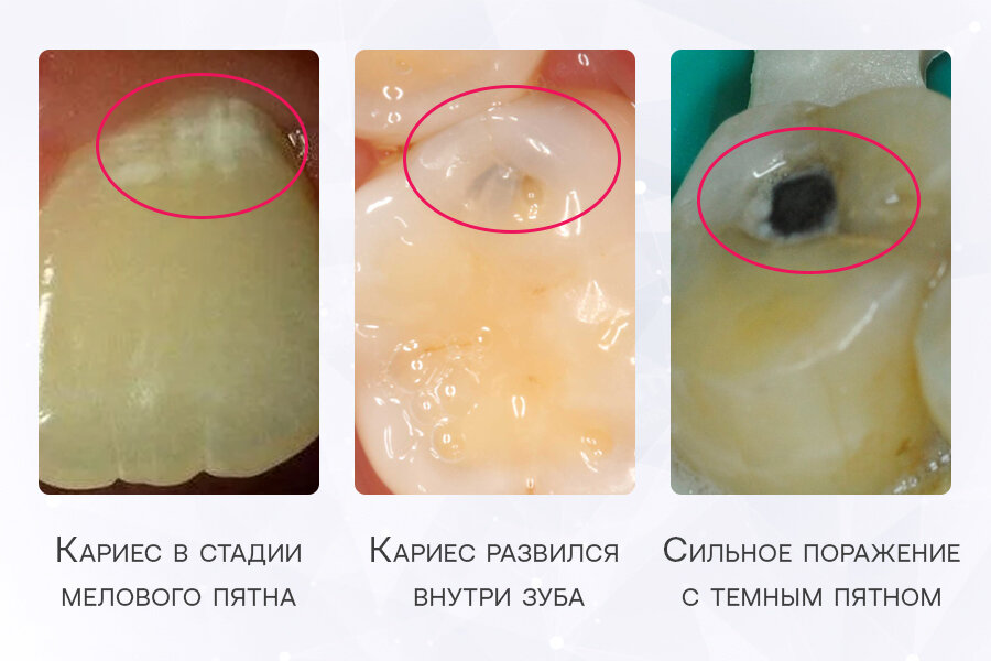 Внешние проявления кариеса могут выглядеть очень по-разному. Фото: Smile-at-Once.ru.
