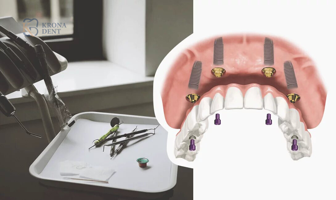 Имплантация All-on-4 - "все на четырех"