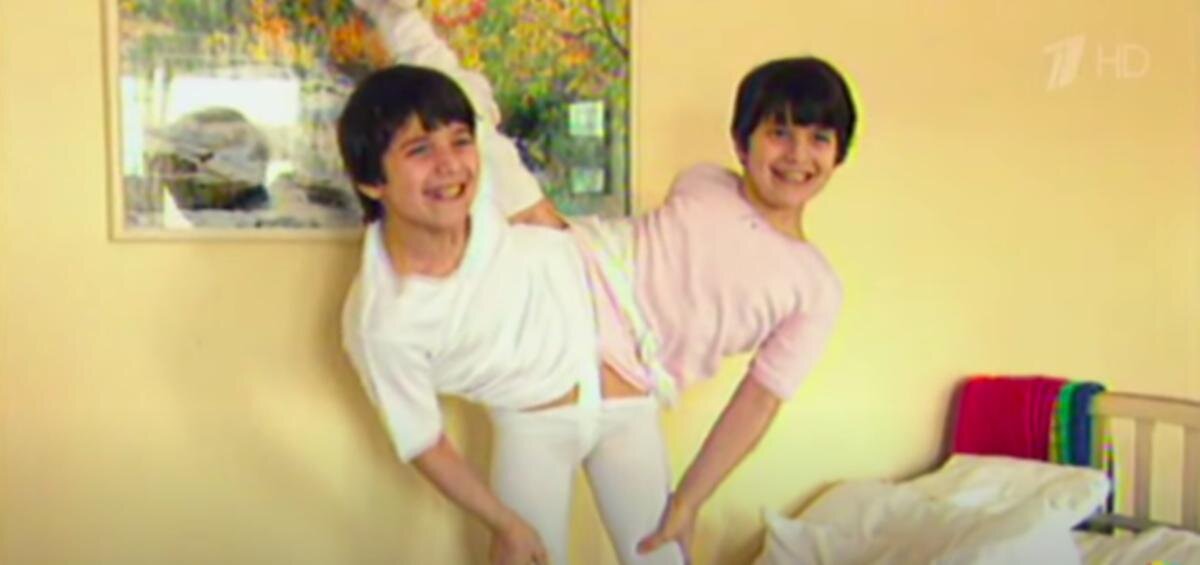 Девочки до операции. Фото в свободном доступе