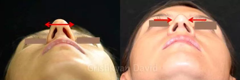 Ринопластика кончика носа фото до и после. Фото с сайта Д.Р. Гришкяна. Имеются противопоказания, требуется консультация специалиста