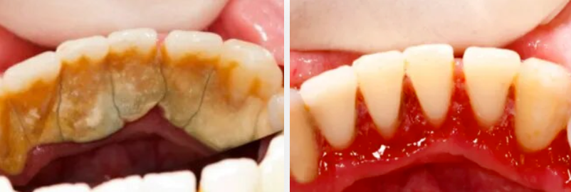 До и после профессиональной гигиены полости рта