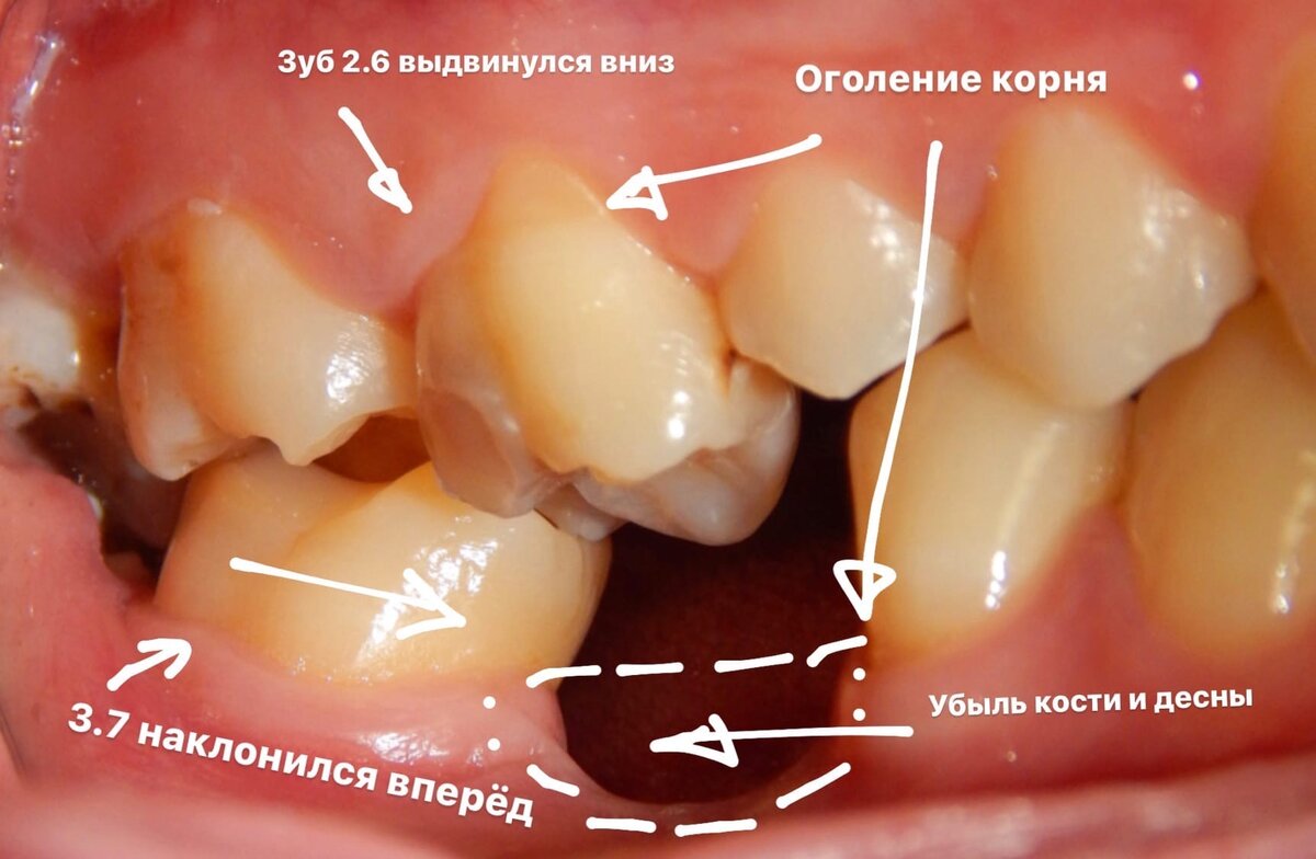 Что делать, если выдвинулся зуб? Об ортодонтическом перемещении отдельных зубов...