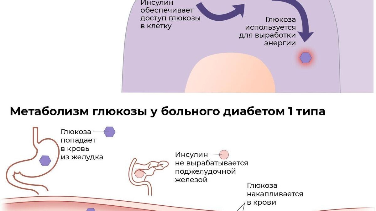    Метаболизм глюкозы у здорового человека и больного диабетом 1 типа© Инфографика