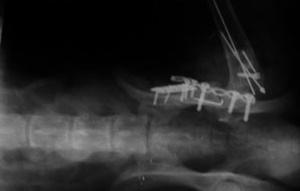 Слева - Асцит при панкреатите. Вызван разрывом поджелудочной железы в результате ДТП.
Справа - После операции жидкость из полости удалена