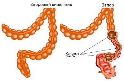 Народные средства от запора: как выбрать лучшее натуральное средство?