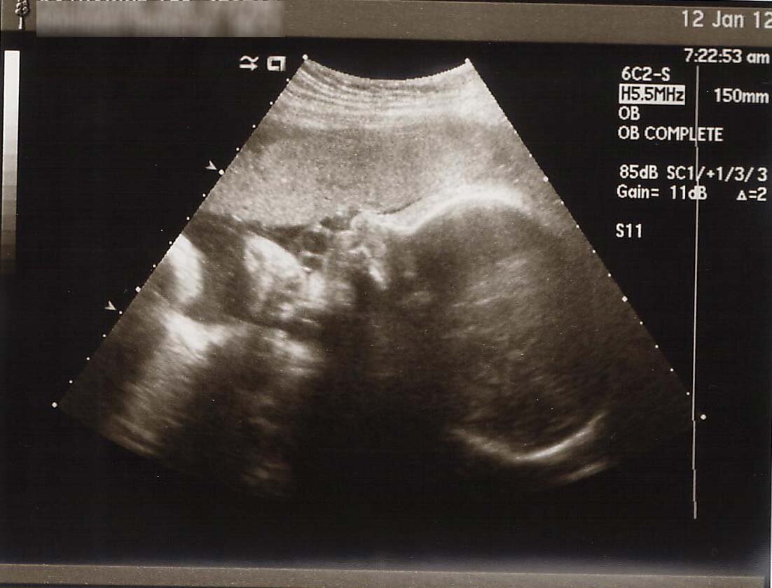 32 недели что происходит с малышом. 32 Недели беременности фото плода на УЗИ. УЗИ плода на 32 неделе беременности. Снимок УЗИ 32 недели беременности. Фото плода на 32 неделе беременности фото.