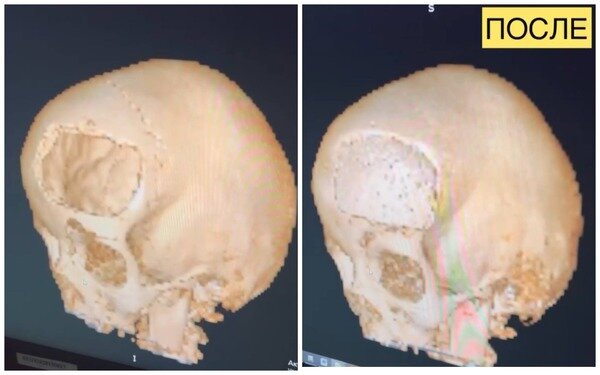    В Оренбурге из-за насморка ребенок лишился части черепа. Воспаление перешло на мозг (видео)
