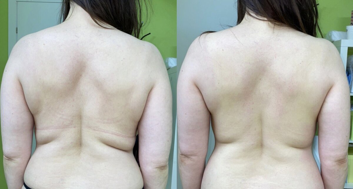 Убираем валики на спине