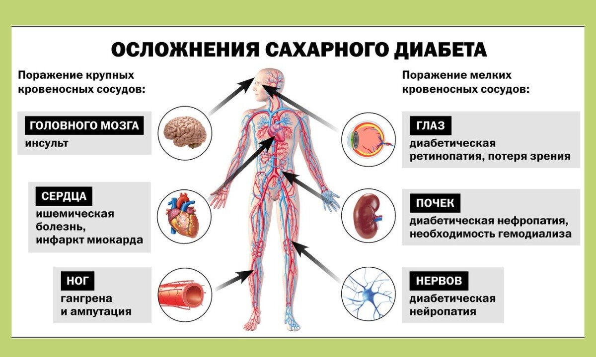 Клиническая картина сд 1 типа