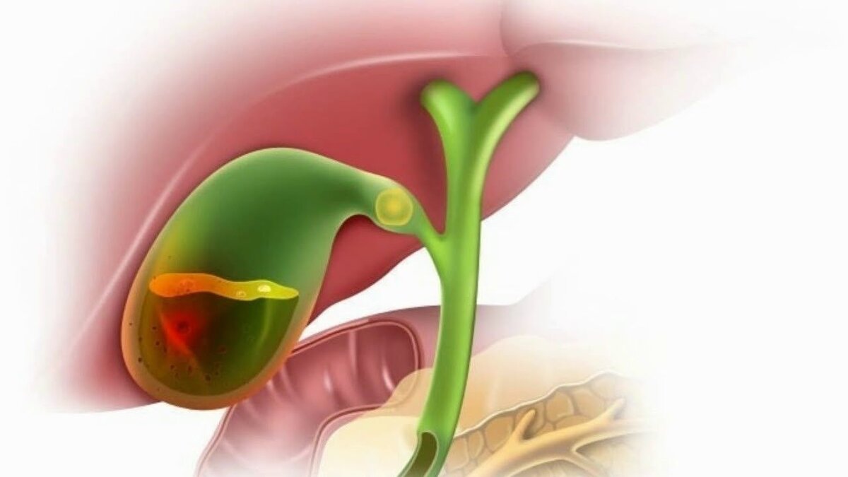 Желчь это. Острый бескаменный холецистит. Некалькулезный (бескаменный холецистит. Острый некалькулезный холецистит.