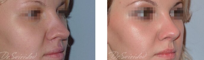 Результаты до и после ринопластики 