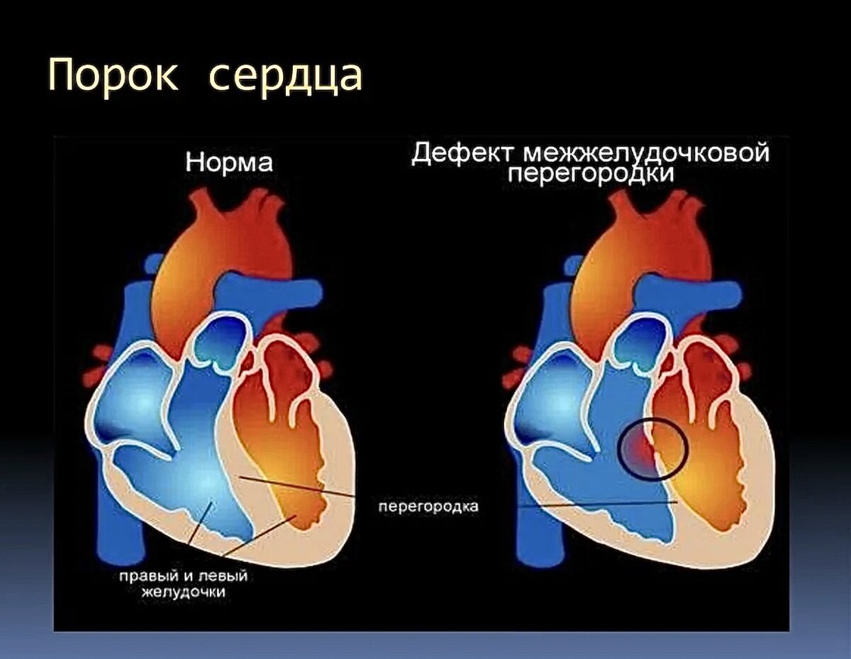 Порок сердца картинки
