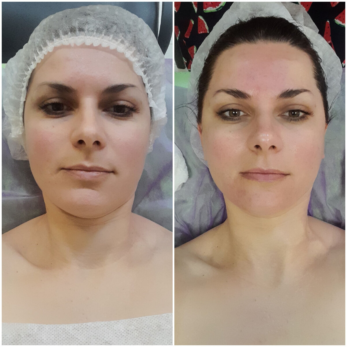 Буккальный массаж 1 процедура