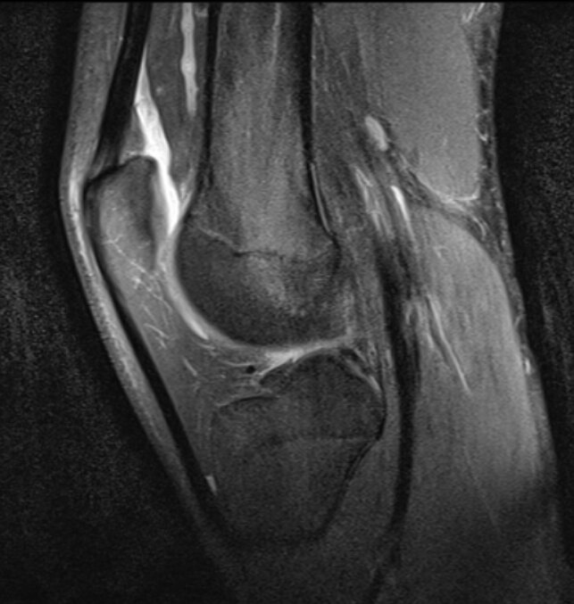 Коленный сустав в сагиттальной плоскости.