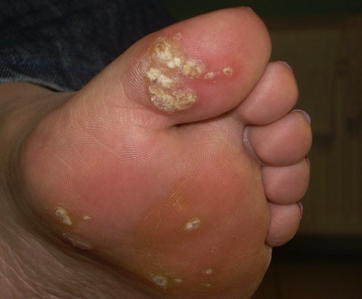 Подошвенная бородавка: что же это и как лечить? Основные вопросы и ответы.