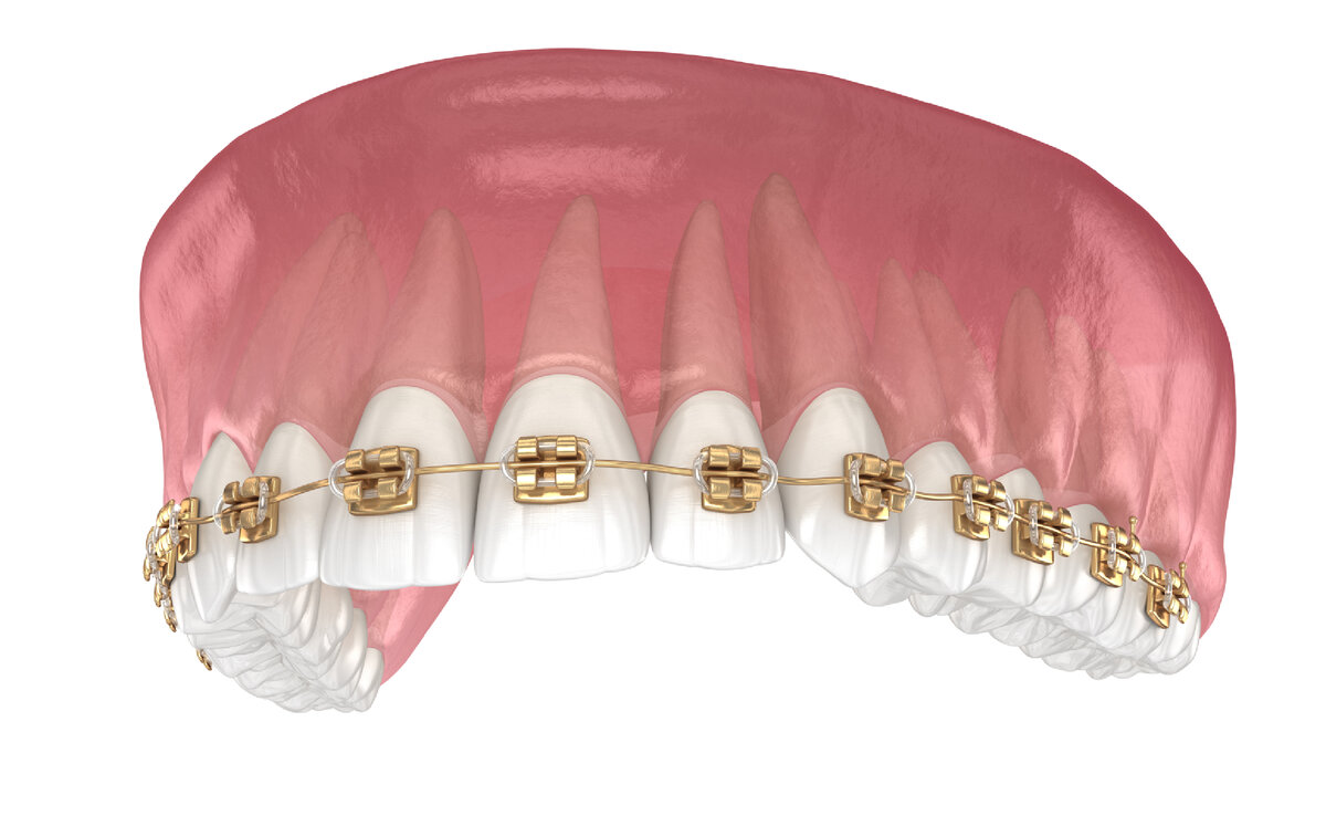Брекеты