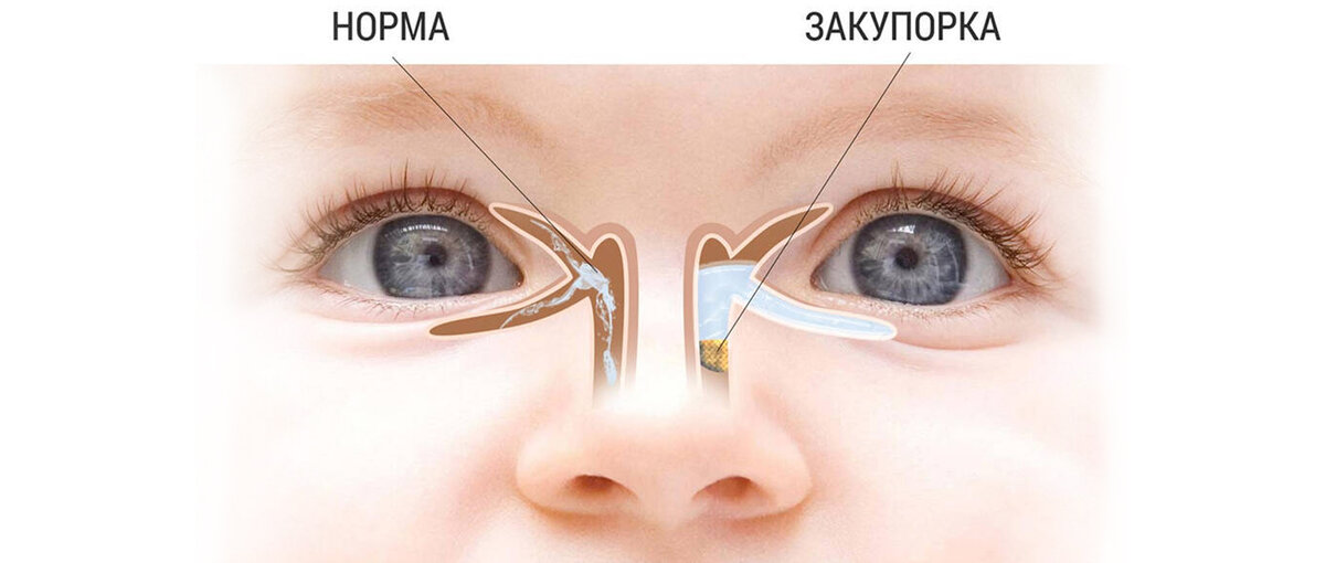 Непроходимость носо-слезного канала у ребенка: симптомы и лечение