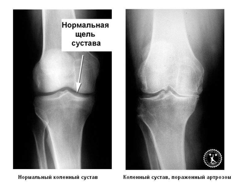 Чем лечить артроз коленного сустава? Сам Себе Ортопед. Спб. Дзен