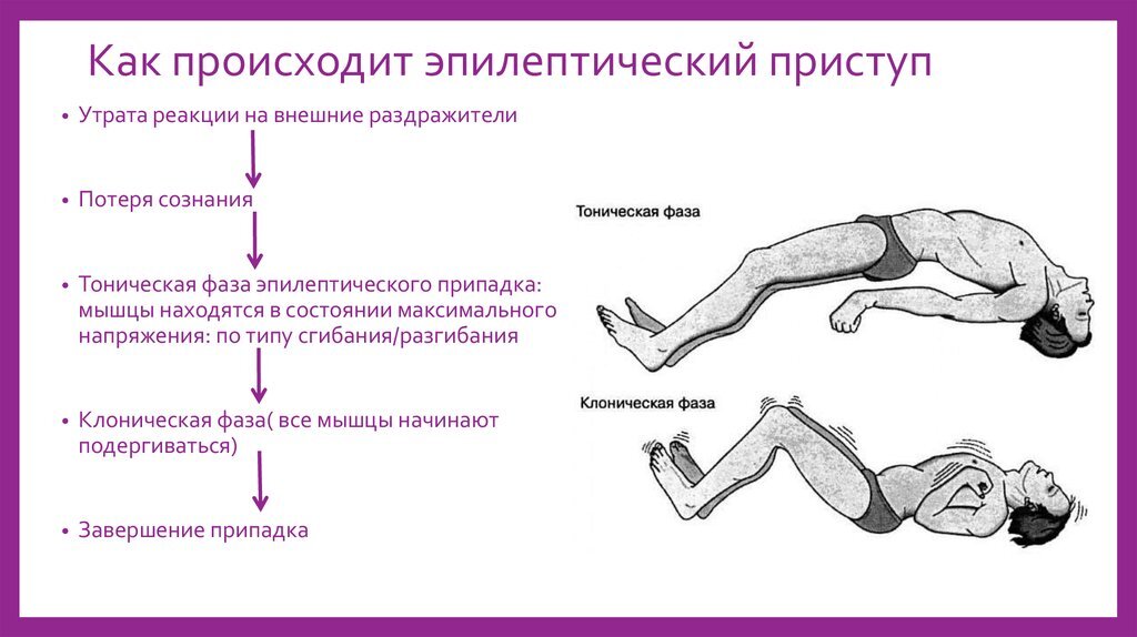 Механизм формирования припадка эпилепсии 