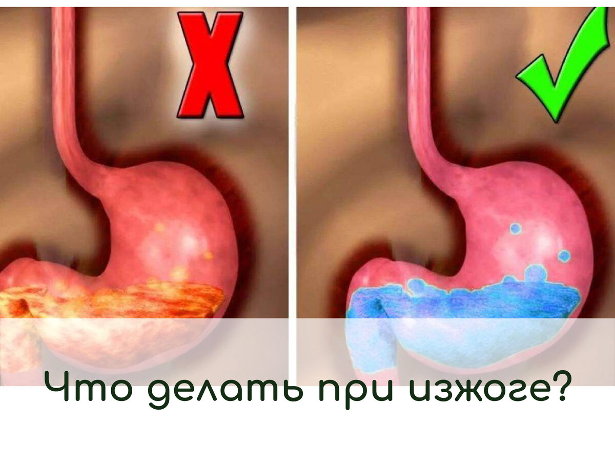 Поднять кровать при рефлюкс эзофагите