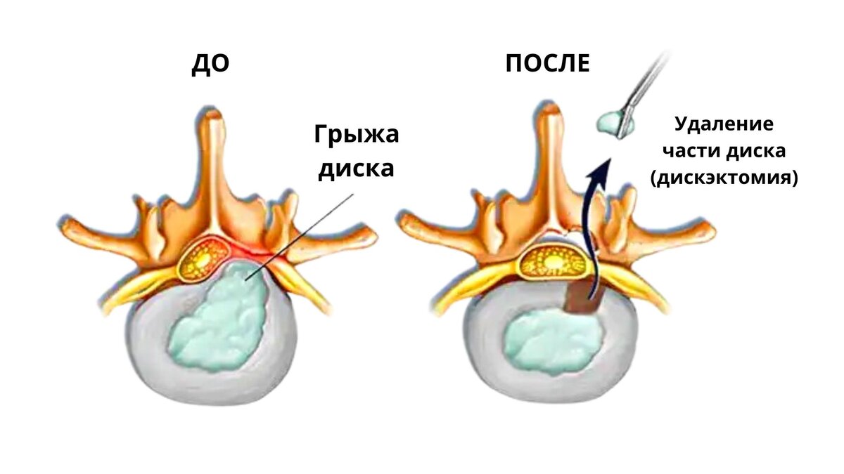 Микродискэктомия