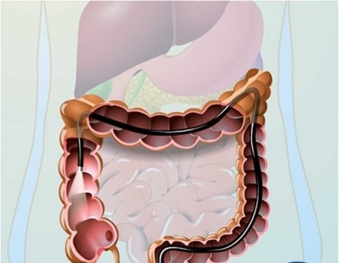 система видеоэндоскопическая св. ректороманоскопия (ректоскопия). проведение колоноскопии. колоноскопияпод нкаркозом. эндоскопическое исследование толстого кишечника.