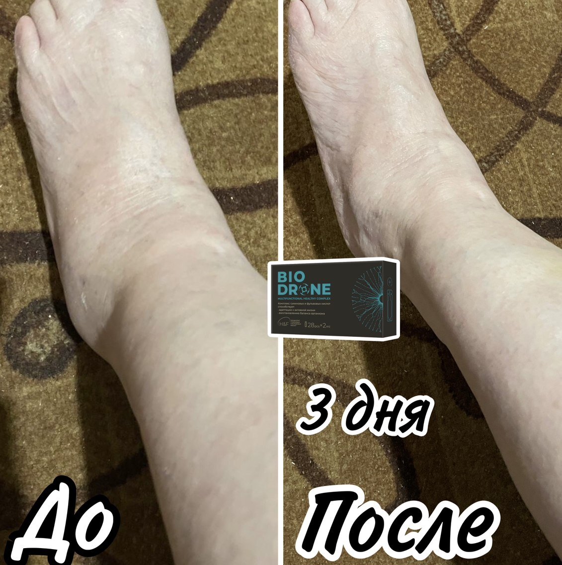 ✅ Хазова Анна, Февраль 2023
Гуминовый комплекс BioDrone

Бабушка (70 лет) мучается с болью в суставах, воспалились суставы и ногу «раздуло», мази и таблетки, прописанные врачами не помогали. Бабушка пьет биодрон по 2 шт в день. Сегодня проснулась бабушка и как ни в чем не бывало, встала, наступать на стопу не больно, удивленно говорит: «Нога - то почти прошла.., ничего себе»
Сделали фото - и действительно, отечность и опухоль прошла. 
3 дня приема всего. Это просто шок. 
Биодрон очень нужный  продукт в каждом доме! 
Самое главное без вкуса и запаха - отлично подойдет даже самому привередливому. 
Волшебный продукт и об этом нельзя молчать.