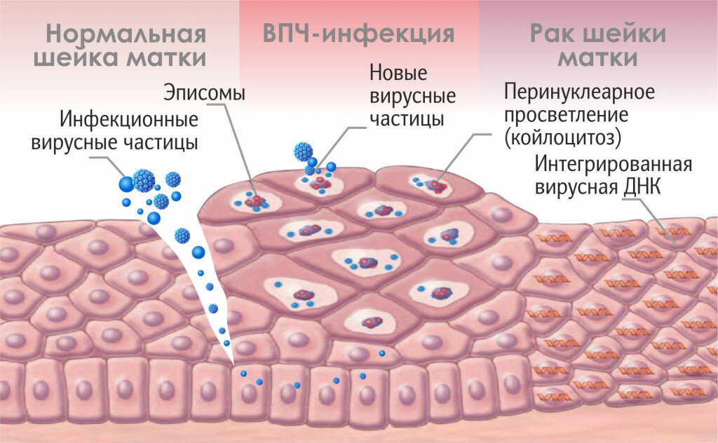 Человека папилломы человека рисунок