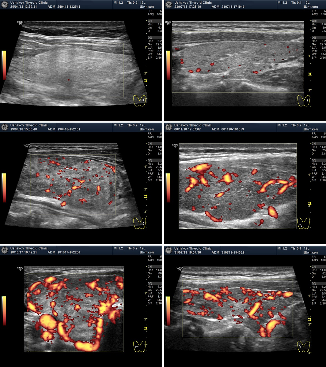 Усилен сосудистый рисунок щитовидной железы усилен