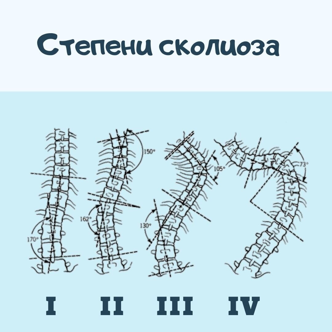 Степени сколиоза