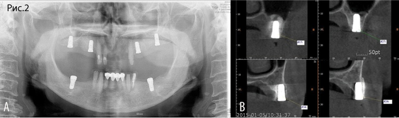 Рис. 2 A. Ситуация после имплантации, синус-лифтинга и расщепления гребня B. КЛКТ через 5 месяцев 
