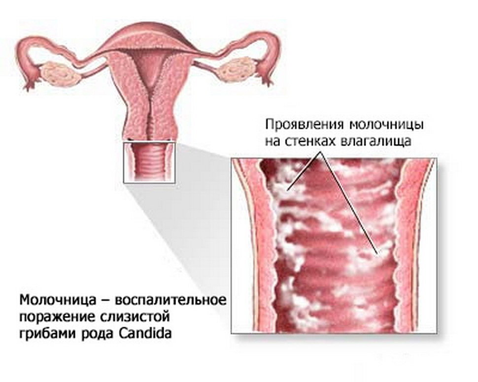 Причины, симптомы и лечение кольпита (вагинит)