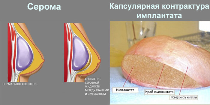 Контрактура молочной железы. Капсулярная контрактура. Капсулярная контрактура молочных желез. Капсулярная контрактура импланта молочной. Капсулярная контрактура импланта молочной железы.