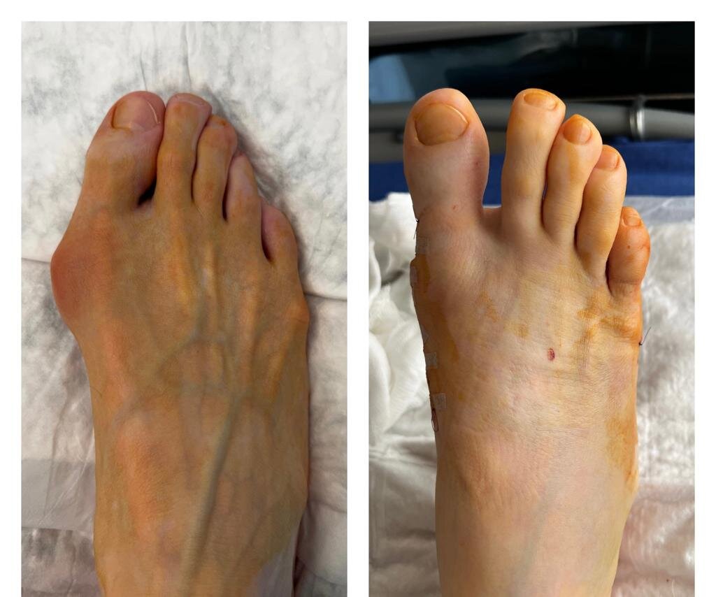 ОПЕРАЦИЯ ПРИ КОСТОЧКАХ, ШИШКАХ, HALLUX VALGUS - что нужно знать и понимать  перед принятием решения | О СУСТАВАХ ПРОСТО И ЧЕСТНО - ортопед Андрей  Карданов | Дзен