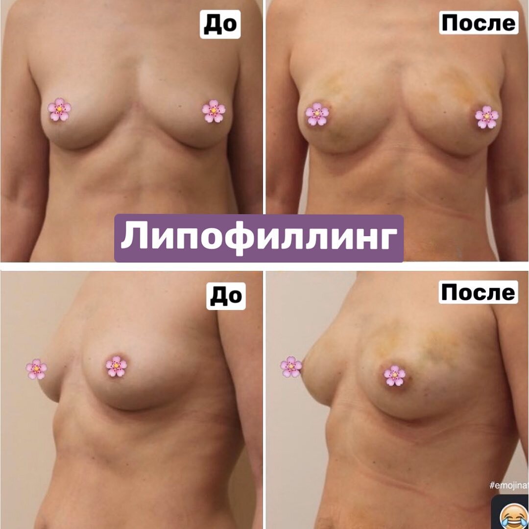 лучший имплант для груди фото 15