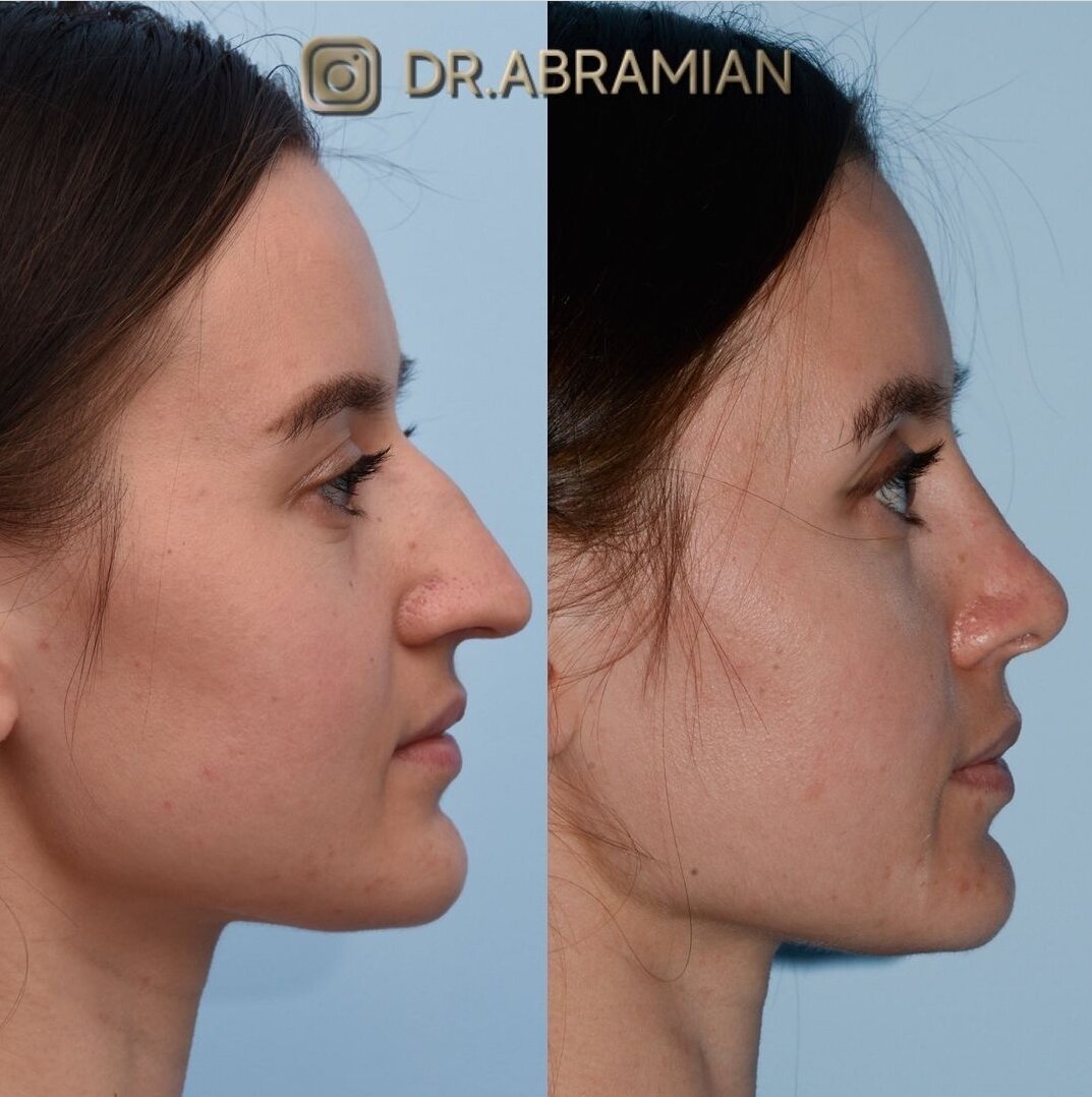 Микроринопластика- Абрамян С. М.