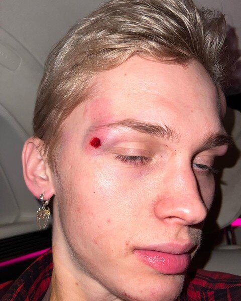 Травмы Дани Милохина