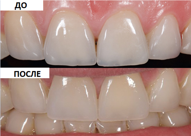 Зубы становятся прозрачными 【Причины и лечение】