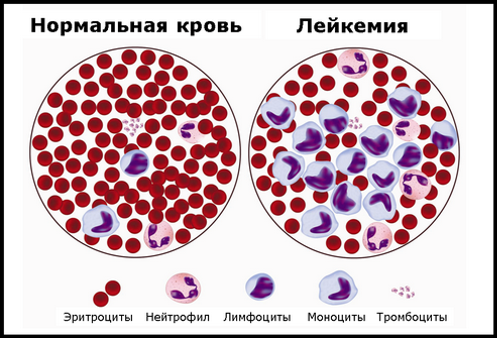 Хронический моноцитарный лейкоз