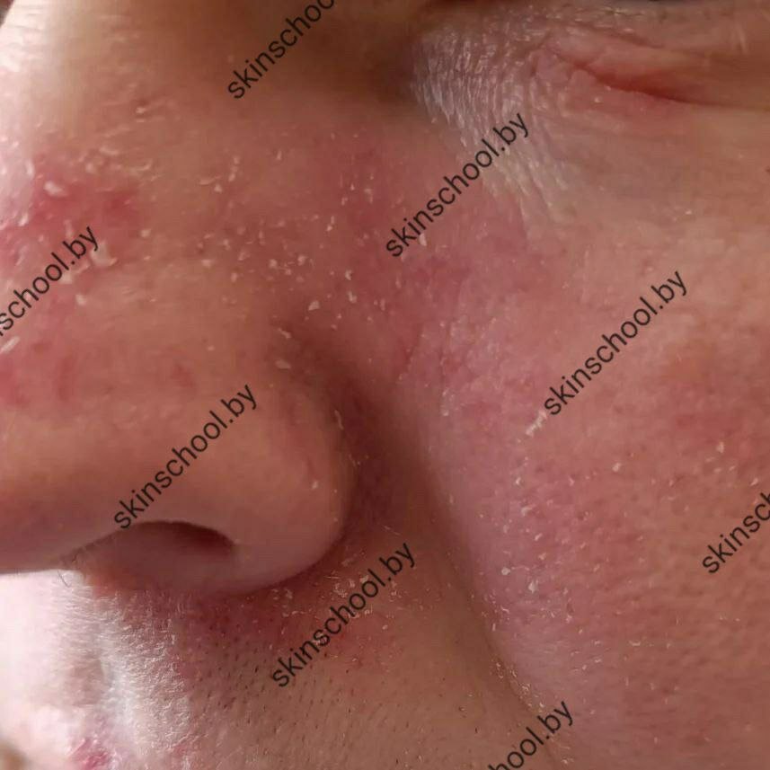 Себорейный дерматит лица | Советы дерматолога|Sovetydermatologa | Дзен