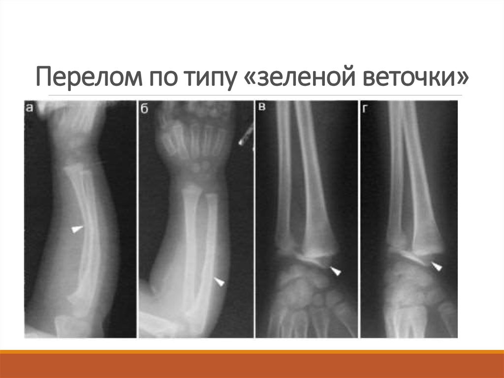 Перелом головки и шейки лучевой кости — статьи клиники «В надёжных руках»