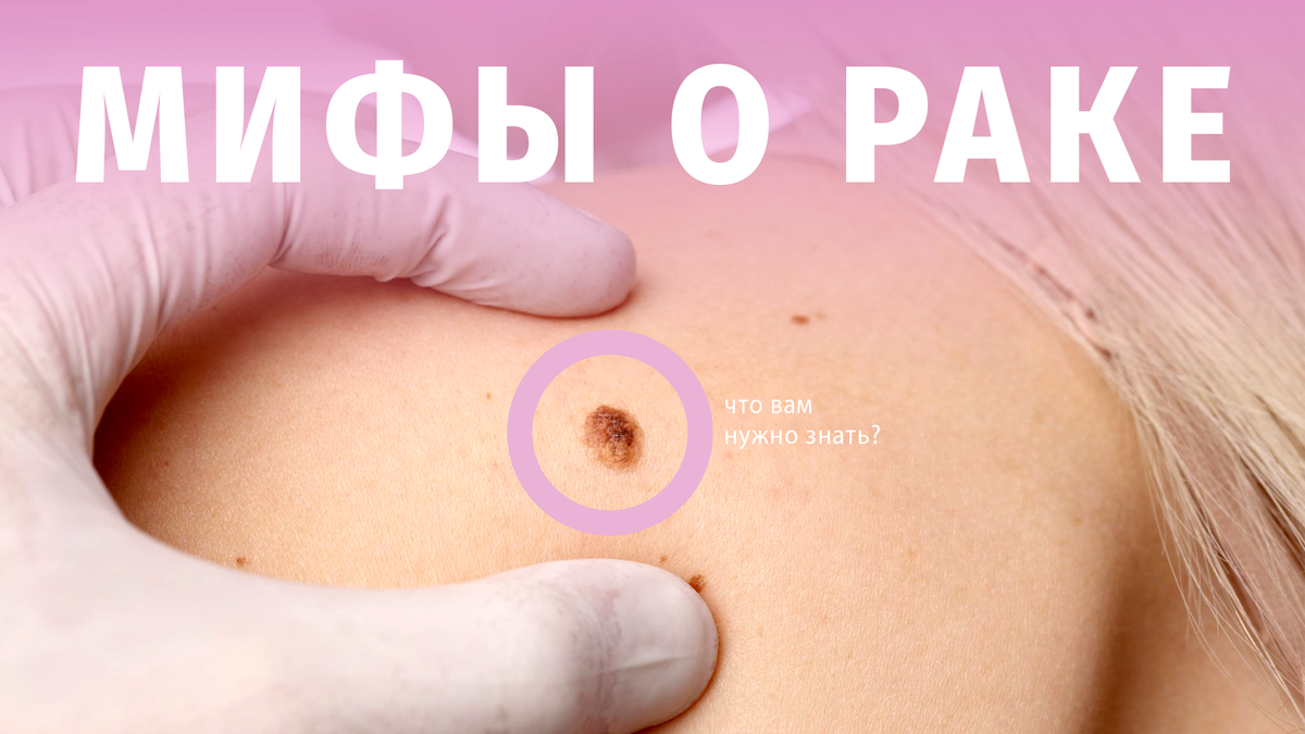 Мифы и факты про меланому